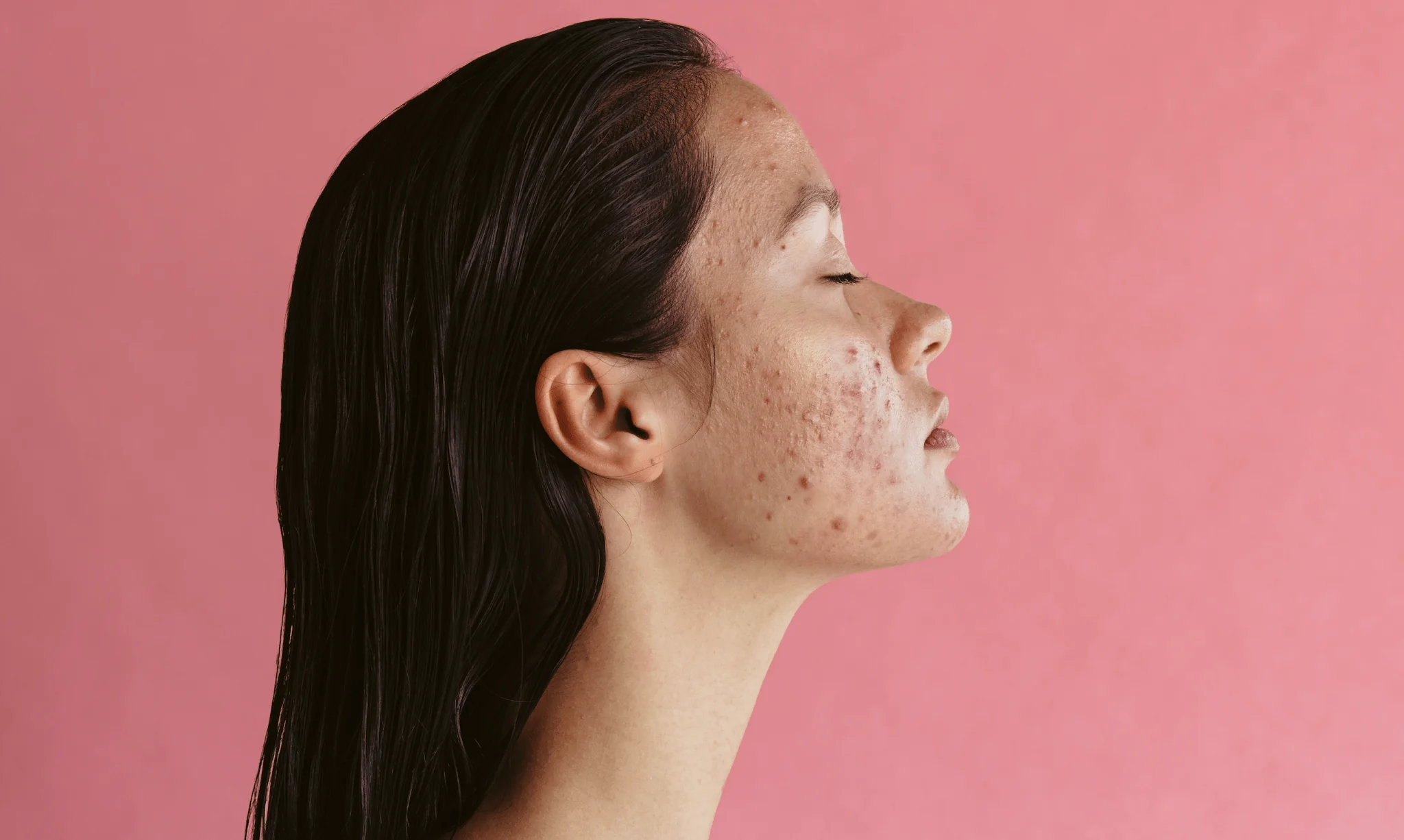 acne-–-i-was-fed-up-with-doctors