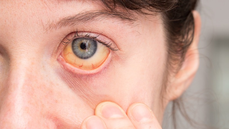 jaundice-the-colour-in-my-eyes-cleared-up